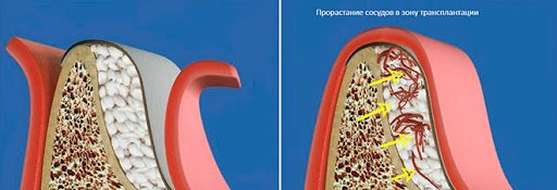 Кісткова пластика, фото-1