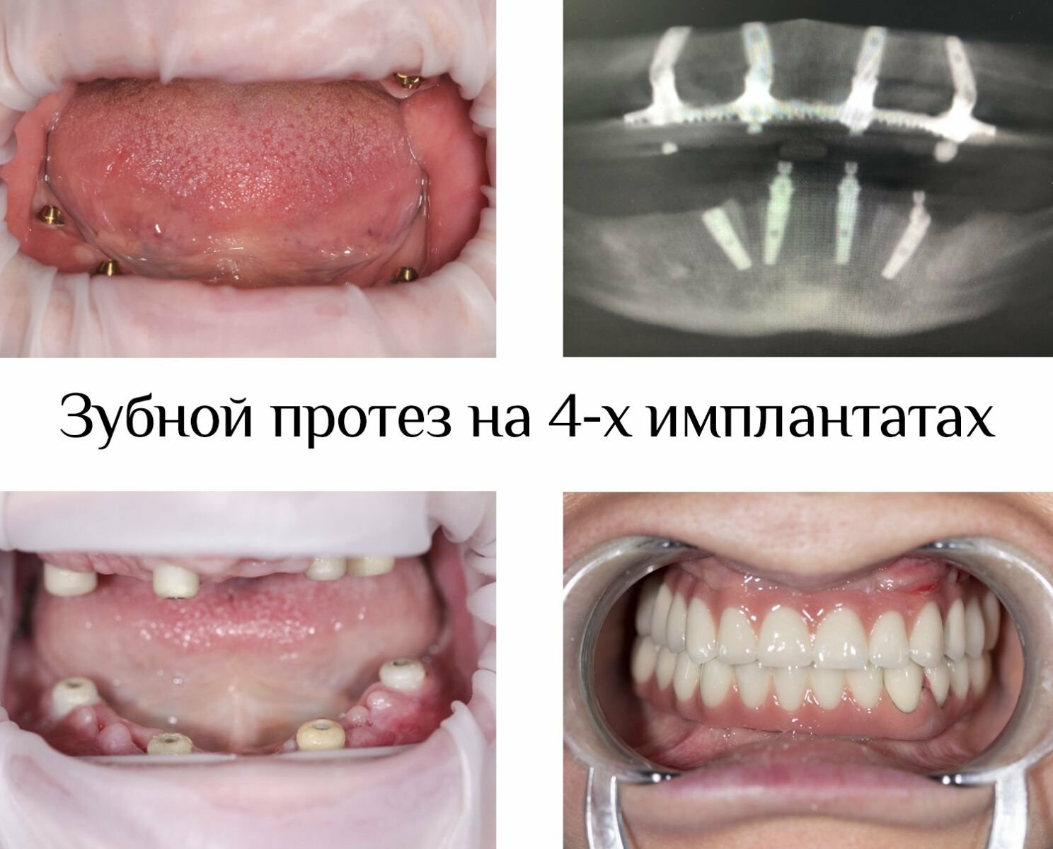 Одномоментна імплантація, фото-2