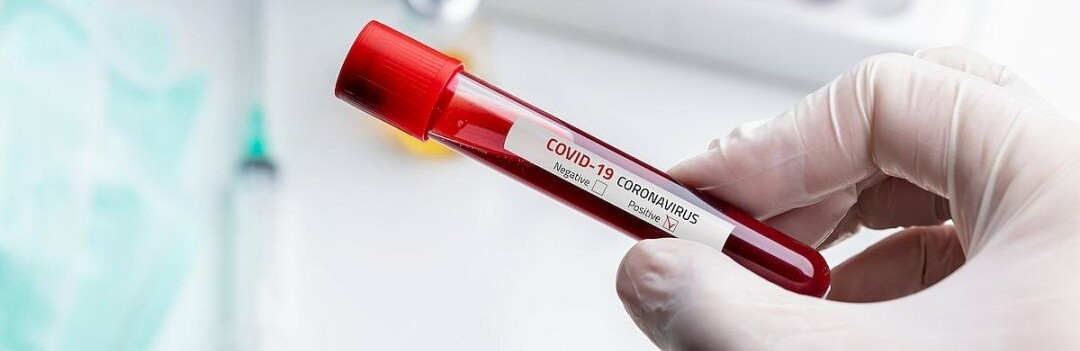 379  новых случаев инфицирования: статистика по COVID-19 в Днепре на утро 14 апреля