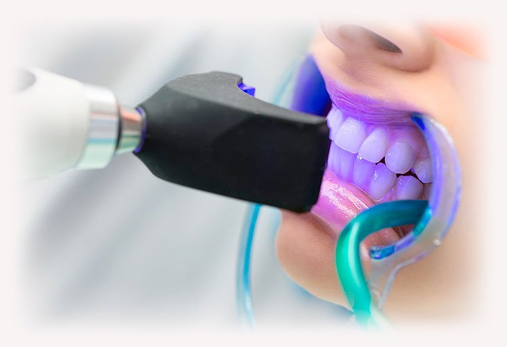 как проводится отбеливание зубов в стоматологии