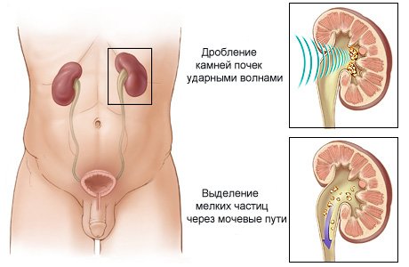 почки камни схема